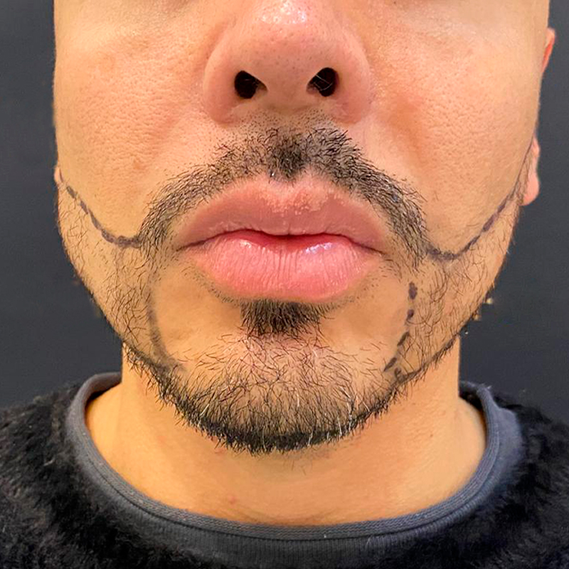 Detalle de barba antes del procedimiento