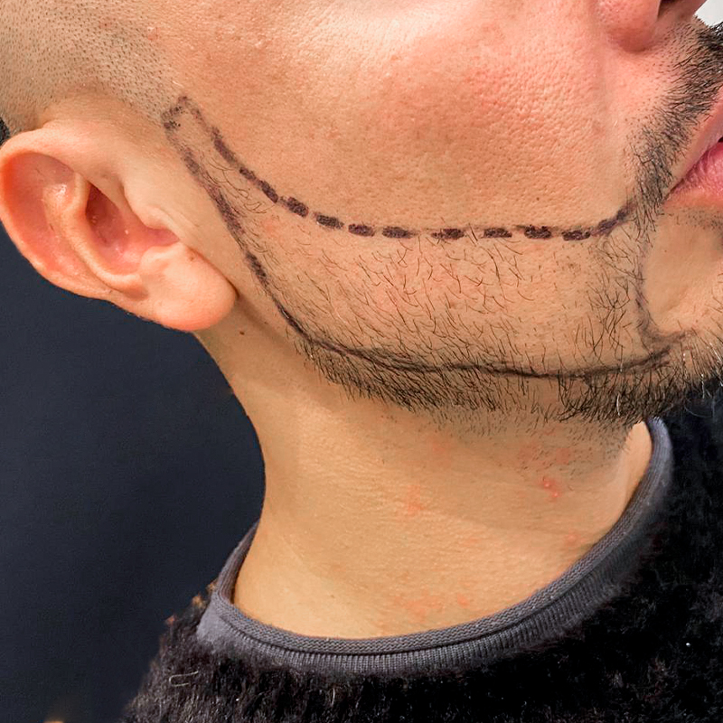 Resultado antes del injerto de barba
