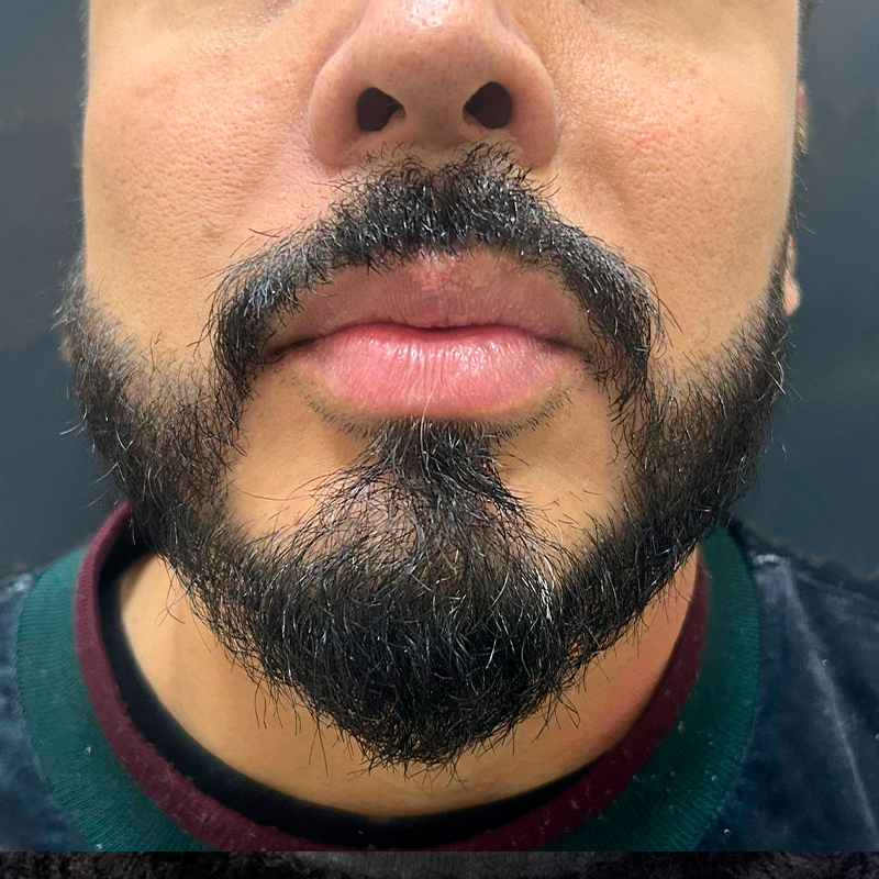 Detalle de barba después del procedimiento