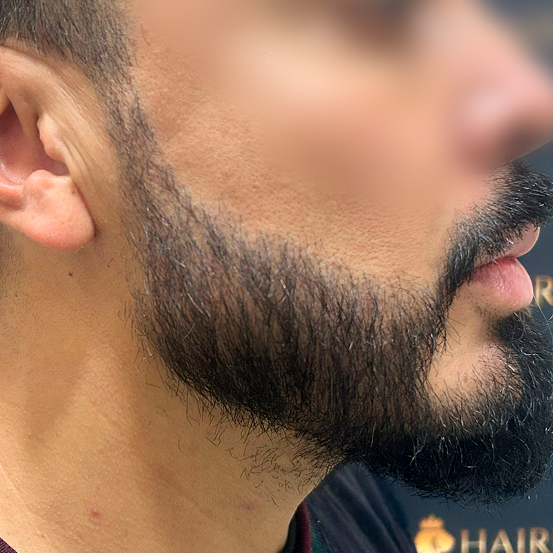 Resultado después del injerto de barba