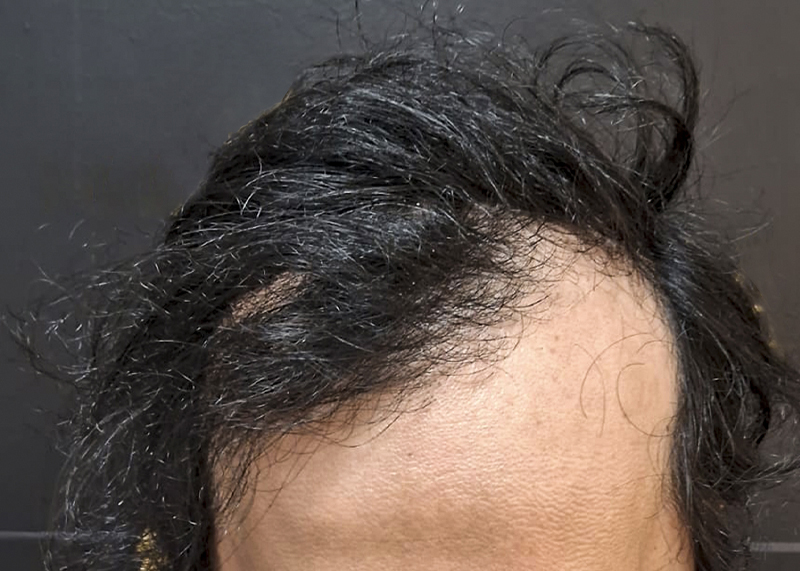 Resultado antes del injerto de cabello