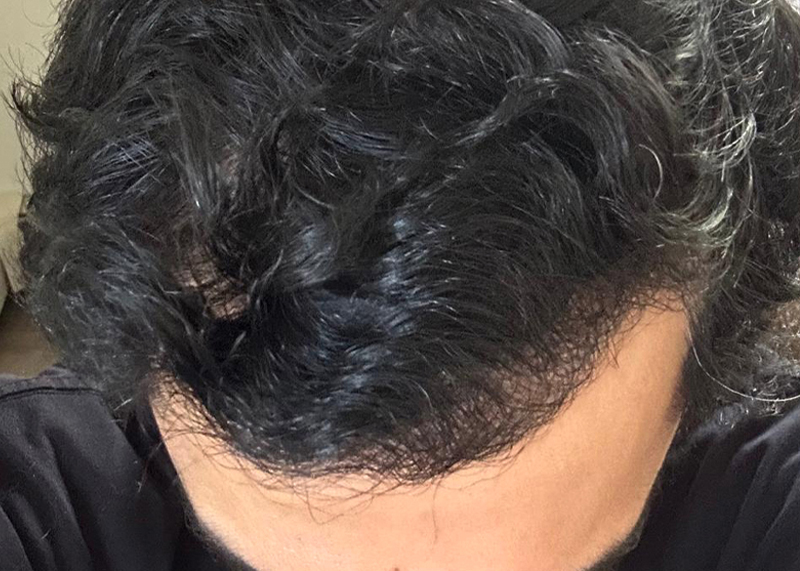 Resultado después del injerto de cabello