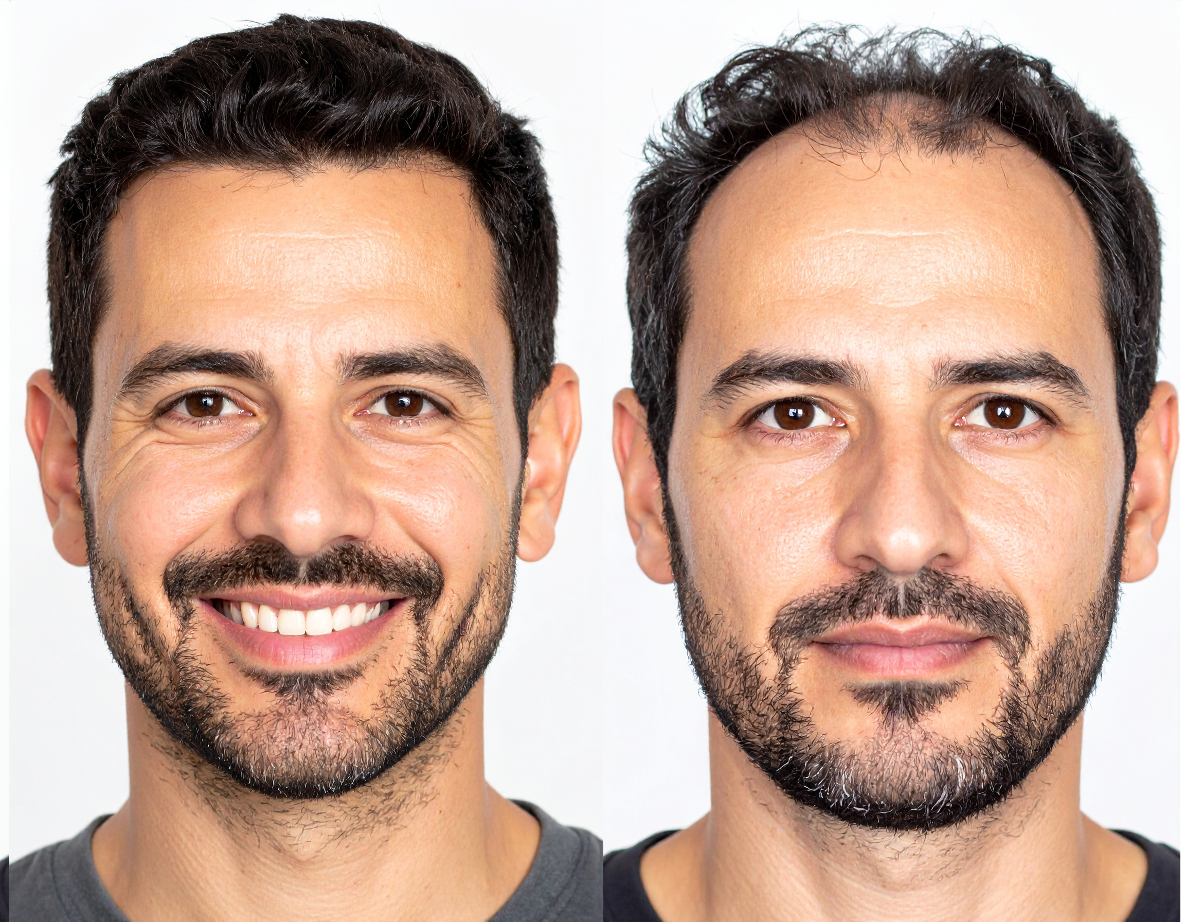 Injerto de cabello